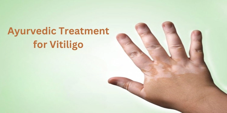 vitiligo treatment in Ayurveda